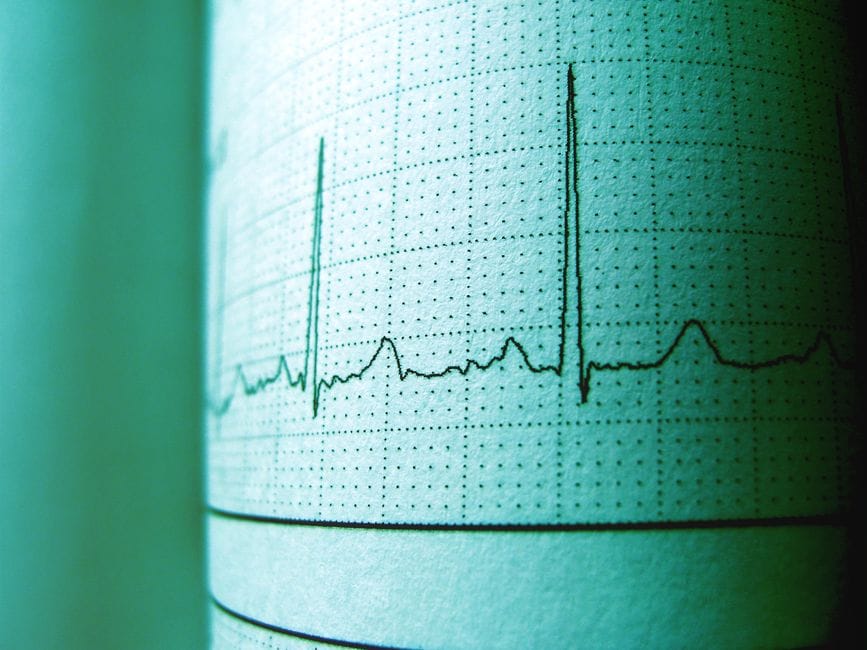 Inhaled Cannabis May Suppress Irregular Heartbeats in Regular Users